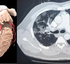 Left, a 3-D rendering of a heart from a cardiac CT exam. Right, a lung-CT exam showing the heart and ground glass lesions in the lungs of a COVID-19 patient. CT has become a front-line imaging modality in the COVID era because it offers both cardiac and lung information to help determine a patients disposition with chest pain, COVID-19 and COVID-caused myocarditis and pulmonary embolism. #COVID19 #CCTfirst #YesCCT