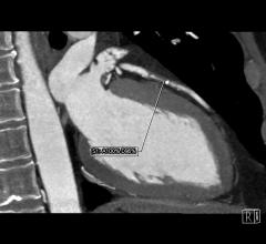 CTA, CCTA, CT angiography, ACC.15, ACC 2015, SCOT-HEART