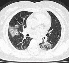 A chest CT scan of a 79-year-old woman who presented with fever, dry cough, and chest pain for three days. Her husband and daughter-in-law had been recently diagnosed with coronavirus disease. The patient expired 11 days after admission.(Courtesy of Song F, Shanghai Public Health Clinical Center, Shanghai, China) #COVID2019 #COVID19 #coronavirus #2019nCoV