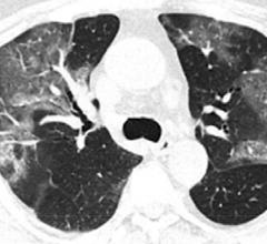 CT image of Novel Coronavirus 2019-nCoV from the Radiology article showing a baseline CT image of a 75 year old male with multiple patchy areas of pure ground glass opacity (GGO) and GGO with reticular and/or interlobular septal thickening. Follow-up CT images on day 3 after admission show an overlap of organizing pneumonia with diffuse alveolar damage in that it is more diffuse and associated with underlying reticulation. Read more and see 15 more images from novel coronavirus patients in the article.