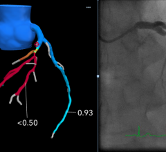 An example of FFR-CT imaging from Beaumont Hospital in Royal Oak, Mich. The left image shows a 3D generated image of the coronary tree from a CT scan evaluated with computational fluid dynamics to determine the FFR numbers. It shows a severe restriction of the left main artery which requires a stent to revacularize. The image on the right is a comparison with the invasive angiogram from the cath lab prior to stenting. 