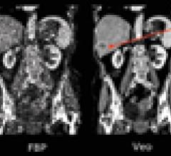 liver metastasis, iterative reconstruction