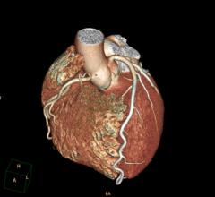 BioImage study, Mount Sinai, cardiovascular disease, ultrasound, CT, detection