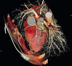 Siemens SOMATOM Sensation 64-slice system offers isotropic resolution of below 0.4 millimeter.