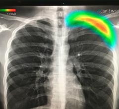 This is a lung X-ray reviewed automatically by artificial intelligence (AI) to identify a collapsed lung (pneumothorax) in the color coded area. This AI app from Lunit is awaiting final FDA review and in planned to be integrated into several vendors' mobile digital radiography (DR) systems. Fujifilm showed this software integrated as a work-in-progress into its mobile X-ray system at RSNA 2019. GE Healthcare has its own version of this software for its mobile r=ray systems that gained FDA in 2019.   #RSNA #