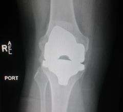 X-ray of a knee replacement. CMS may change reimbursements for joint and knee replacements. Patient Marilyn Fornell.