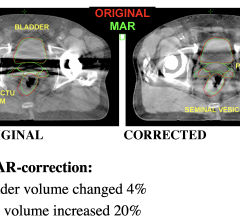 Metal artifact reduction led to a 20 percent increase in the planning target volume (PTV) in this prostate cancer case from Henry Ford Health System. The volume of the healthy bladder tissue to be spared was also reduced by 4 percent. 