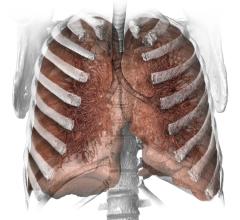 smoking, lung cancer, CT screening, guidelines