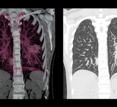 A low-dose lung CT scan can be used to help detect mesothelioma. 
