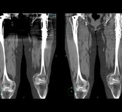 CT image iterative reconstruction iDose4 software from Philips showing improvement in image quality.
