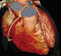 A 3-D rendering of a cardiac CT angiography imaged by a Siemens Somatom Definition Flash CT scanner.