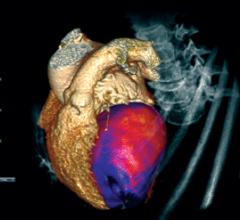 perfusion imaging, CT perfusion