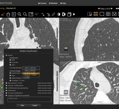 low-dose CT, LDCT, lung cancer, screening, nonsolid nodules, Mount Sinai