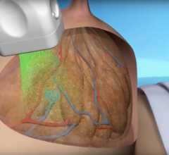 An example of opto-acoustic breast imaging using the Seno system.   