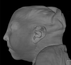 Zika virus, imaging zika, CT scans of Zika, MRI scans of zika, radiology of Zika, medical imaging of zika