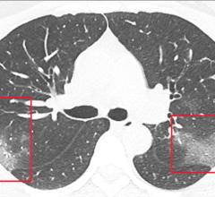 Figure A: CT scan of a coronavirus from a patient in China showing ground glass lesions in the lungs. Images courtesy of the Radiological Society of North America. For larger images and more details on the scan, view the original article at https://pubs.rsna.org/doi/10.1148/radiol.2020200236