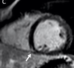 Figure 1. MRI shows late gadolinium enhancement (LGE) at the right ventricular attachment (arrow) of a 19-year-old male. Note: this image is for illustrative purposes only and is not associated with the Big Ten study group. Image courtesy of Radiology.
