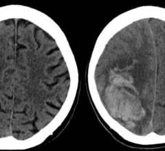 Figure 1. The left image shows the initial CT scan of the brain in a patient on both clopidogrel (Plavix) and aspirin who presented to the Emergency Department with head trauma that did not demonstrate any intracranial hemorrhage. The right image shows a head CT obtained 24 hours later demonstrating a large parenchymal hemorrhage in the right.