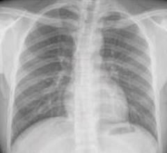 Figure 1. Normal chest X-ray