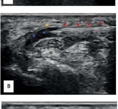 Figure 1. Ultrasound images depicting hydrodissection procedure in a patient with carpal tunnel syndrome. (A) Needle placed below the median nerve with fluid dissecting the nerve from the underlying flexor tendons (green star). (B) Needle placed above the median nerve with fluid dissecting the nerve away from the flexor retinaculum (yellow star). (C) Image at completion of procedure depicting the dissected median nerve with fluid all around. Red Arrow - needle, Blue cross -hydrodissection fluid, white dashe