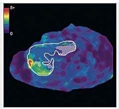 UC San Diego study, liver fibrosis, MRE, magnetic resonance elastography