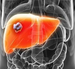 The research collaboration agreement covers a joint clinical retrospective study on liver fibrosis severity in Non-Alcoholic Steato-Hepatitis (NASH) patients