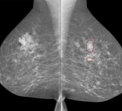 iCAD Introduces ProFound AI for 2D Mammography in Europe