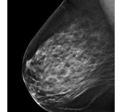 he U.S. Food and Drug Administration (FDA) has issued a final order to reclassify medical image analyzers applied to mammography breast cancer, ultrasound breast lesions, radiograph lung nodules and radiograph dental caries detection, postamendments class III devices (regulated under product code MYN), into class II (special controls), subject to premarket notification