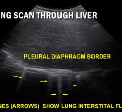 #COVID19 #Coronavirus #2019nCoV #Wuhanvirus #SARScov2 Sonogram taken under rib cage shows liver (grey) with curved diaphragm-lung border (white). Arrows point to vertical B lines (white) demonstrating diseased lung tissue. The more B lines the worse the disease. Healing is measured by reduction in the number of B lines.