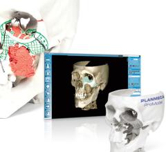 Planmeca ProModel, 3-D printing, first Nordic facial tissue transplant procedure