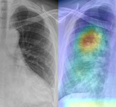 World’s largest deployment of a radiology-based AI diagnostic solution for COVID-19 using AI-based chest X-ray technology