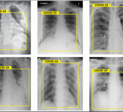 What does COVID look like on X-ray, CT, medical imaging? Radiologic presentations of COVID-19.  An example of a COVID-19 pneumonia of a chest CT scan. The COVID appears as white ground glass opacities (GGOs) in the lungs. Normal lungs on CT should appear black. #COVID #COVID19 #Coronavirus