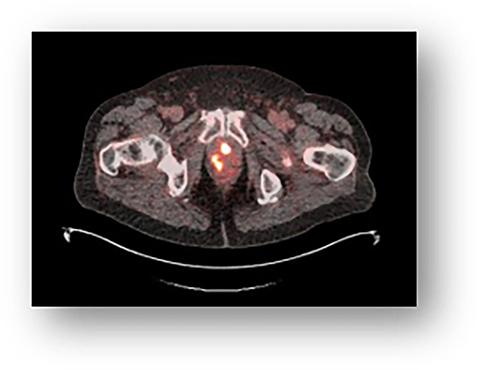 18F-rhPSMA-7.3 PET image showing multiple areas of uptake in the prostate gland in a man with newly diagnosed prostate cancer Photo courtesy of Blue Earth Diagnostics 
