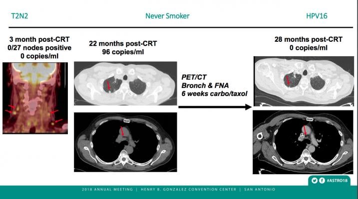 Biomarker blood test accurately confirms remission in non-smoker with HPV-associated oral cancer. ASTRO 2018 #ASTRO2018 #ASTRO #ASTRO18