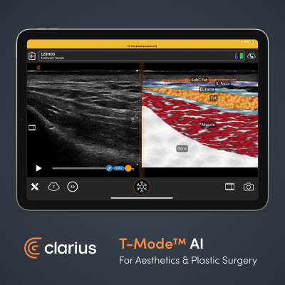 T-Mode AI by Clarius creates a split screen during an exam that displays a colorful anatomical image with labels next to the grayscale ultrasound image