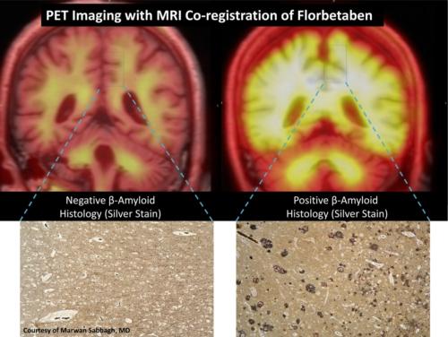 Alzheimer's Disease Clinical Trial/Study PET Systems MRI 