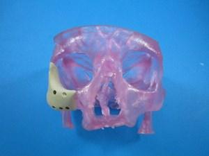 3-D Printed OsteoFab Patient-Specific Facial Device