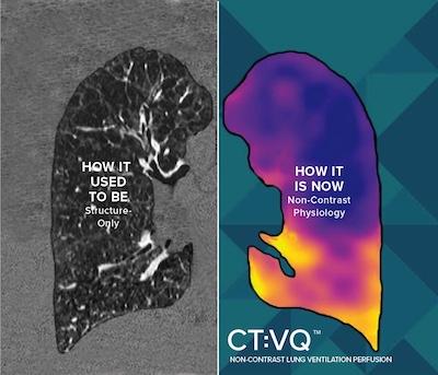 FDA Clearance Granted to 4DMedical's CT:VQ