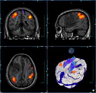 Invivo CorTechs Labs NeuroQuant MRI System Advanced Visualization