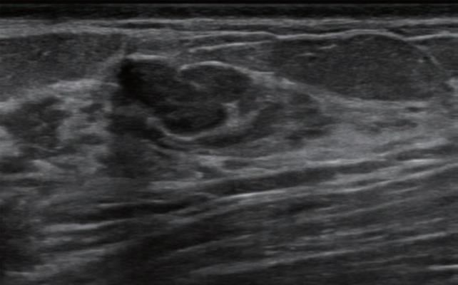 Computer‐Aided Diagnosis Improves Breast Ultrasound Expertise in Multicenter Study