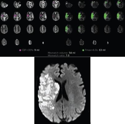 54-year-old patient with COVID-19 who underwent full angiographic reperfusion (extended thrombolysis in cerebral ischemia score = 3) after acute ischemic stroke. 