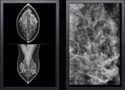VuComp, M-Vu CAD, digital breast tomosynthesis, DBT