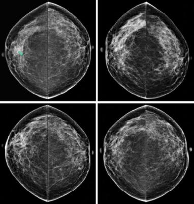 ACR Recommends More Aggressive Breast Cancer Screening for Higher-Than-Average-Risk Women