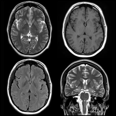 MRI Shows Brain Differences Among ADHD Patients