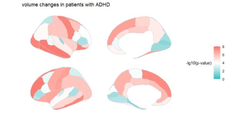 Figure 1. Volume changes in patients with ADHD. Children with ADHD tend to have lower cortical volume, especially in temporal and frontal lobes.