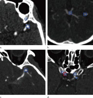 Images show examples of false-positive aneurysms, including (a) bony structures and vessel bifurcation, (b) veins, (c) vessel curvatures, and (d) calcified plaques. Red box (d) indicates aneurysms annotated by radiologists, and the blue boxes indicate aneurysm candidates provided by the algorithm. Images courtesy of the Radiological Society of North America