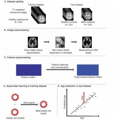 Researchers have developed an artificial intelligence (AI)-based brain age prediction model to quantify deviations from a healthy brain-aging trajectory in patients with mild cognitive impairment, according to a study published in Radiology: Artificial Intelligence. The model has the potential to aid in early detection of cognitive impairment at an individual level.