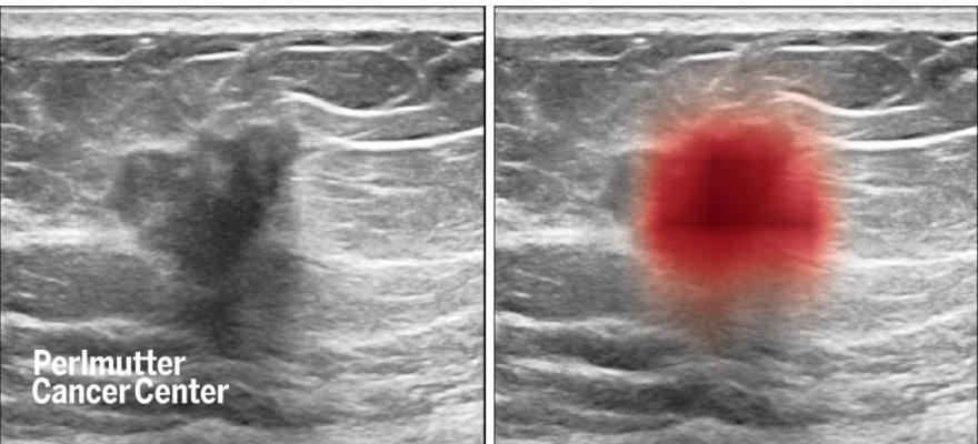 September 28, 2021 — A computer program trained to see patterns among thousands of breast ultrasound images can aid physicians in accurately diagnosing breast cancer, a new study shows.