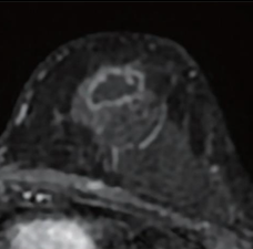 MRI Model Predicts Neoadjuvant Chemoimmunotherapy Response in Triple-Negative Breast Cancer