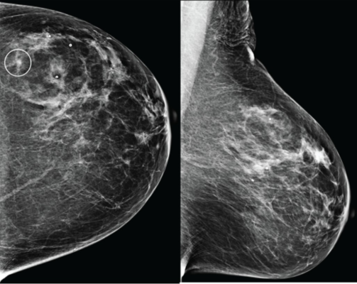 AI Helps Achieve Higher Negative Predictive Value, Recall Rates